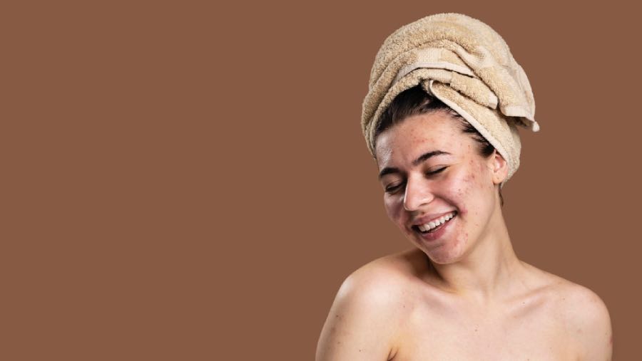 รอยสิวมีกี่ประเภท รอยสิวมีกี่ประเภท